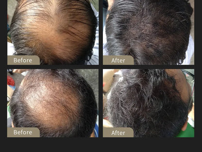 SEVICH Hair Building Fiber Set